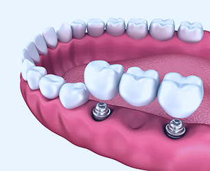 How Do Implant Supported Dentures Work? - Lake Norman Dentistry  Huntersville North Carolina
